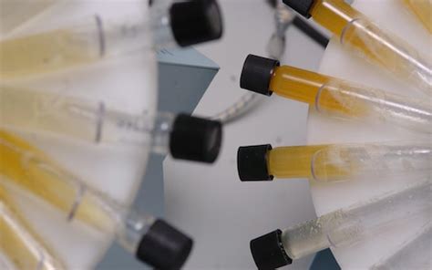 simple urine test  ovarian cancer   radically improve survival rates   horizon