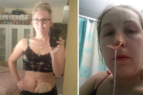 Woman Diagnosed With Anorexia After Extreme Weight Loss