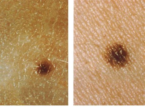 How To Check A Mole On Your Skin For Skin Cancer Business Insider
