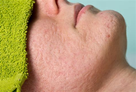 open pores types  symptoms medical treatment