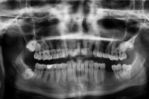 broken jaw east valley dental professionals