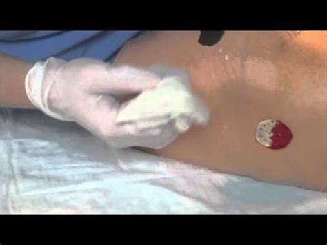 obtaining  wound culture youtube