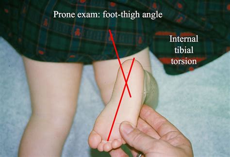 internal tibial torsion pediatrics orthobullets