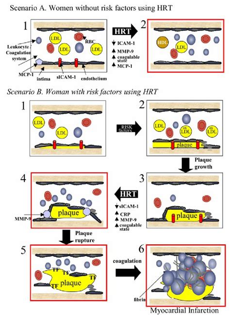 Role Of Hormone Replacement Therapy Hrt In Atherogenesis