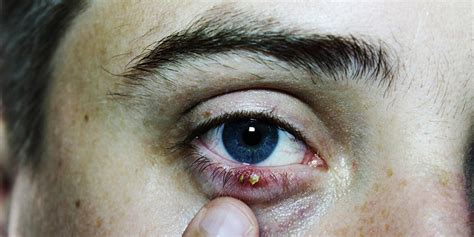 eye stye treatment what causes eye styes men s health