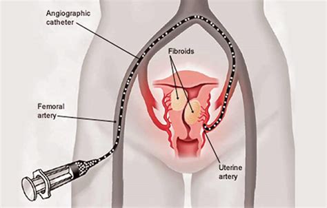Uterine Fibroid Embolization St Johns Vein Center