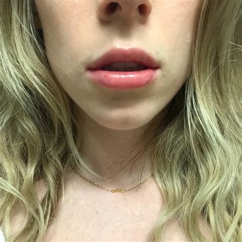 Exactly What To Expect From Lip Fillers Into The Gloss