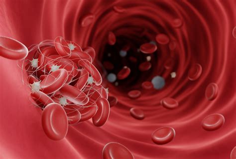 blood clotting disorders carda health