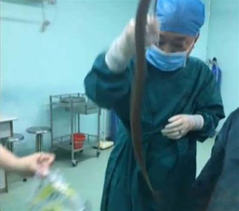 Man Gets Eel Stuck Up His Anus But Won T Tell Doctors How It Got There