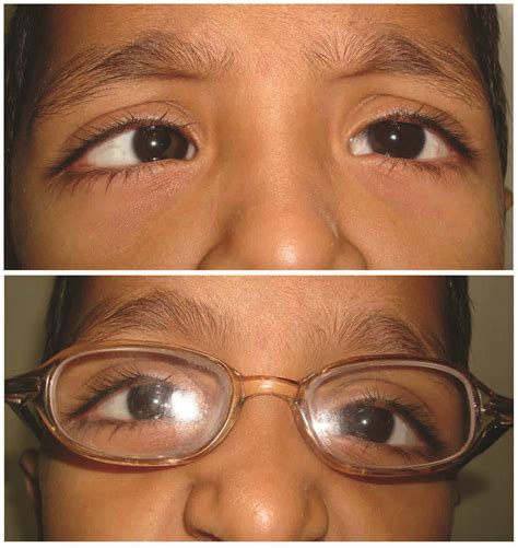 convergent squint esotropia utsav eye clinic