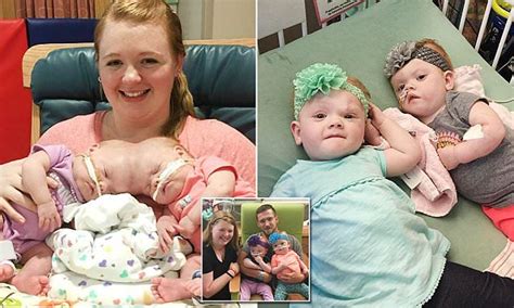 once conjoined twins are going home for thanksgiving daily mail online