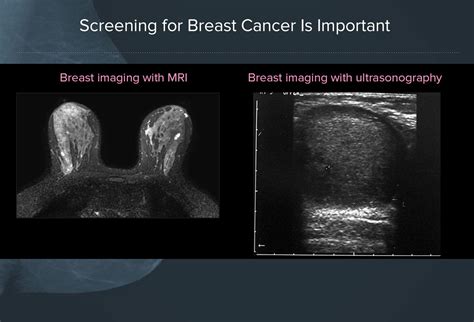 Mammography Screening Guidelines