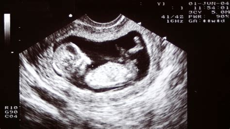 week ultrasound scan  pregnancy raising children network