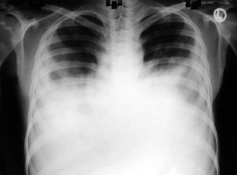 Chest X Ray Revealed Bilateral Pleural Effusion Open I