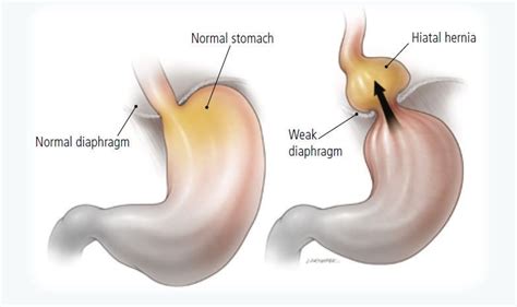 Gastroesophageal Reflux Disease Gerd Guide Causes Symptoms And