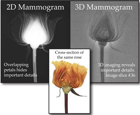 Is A 3d Mammogram Really Better Than A 2d Mammogram