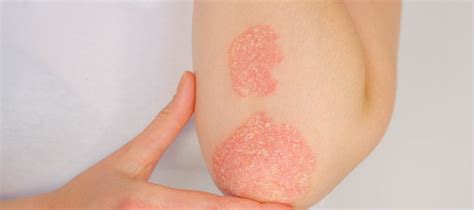 Top 7 Home Remedies For Psoriasis American Academy Of Medicine
