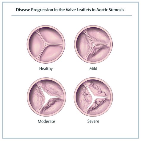 aortic stenosis treatment options asian heart vascular centre ahvc