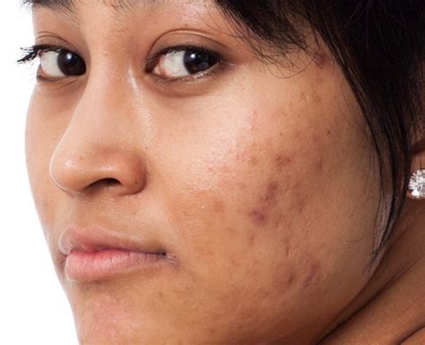 skin pigmentation  effect  face beauty  xerxes