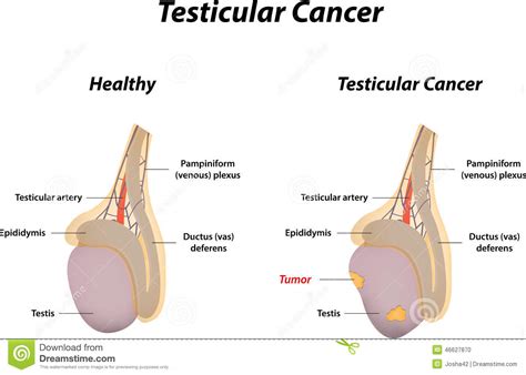 Testicular Cancer Stock Vector Illustration Of Testicles 46627870