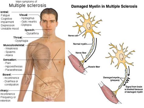 multiple sclerosis sclerosis disseminated multiple sclerosis acute