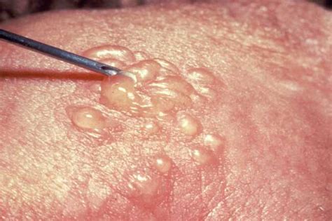 pictures of viral rashes