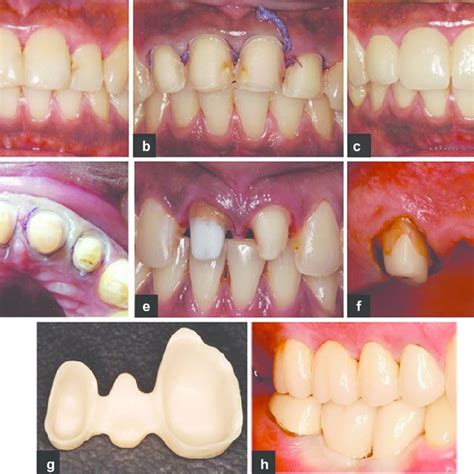 periodontal considerations determining  design  location