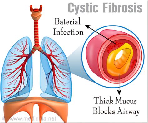 Cystic Fibrosis Gene