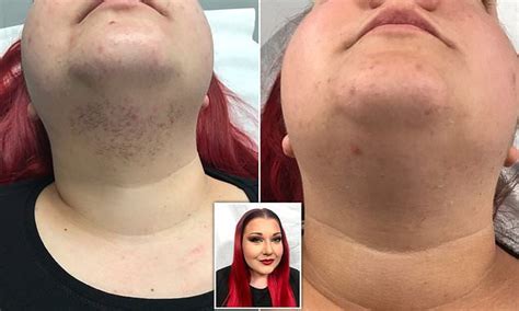 Woman With Pcos Who Started Growing Facial Hair In Her 20s Reveals