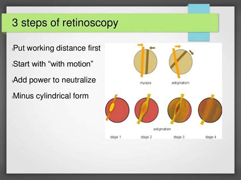 retinoscopy  pratyush