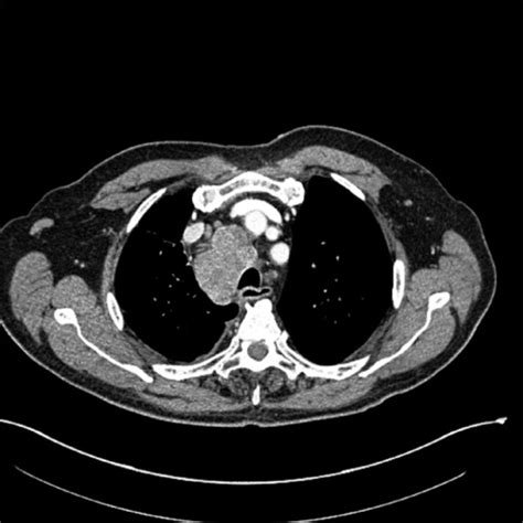 Ct Image Of Chest Showing Right Hilar Mass And Enlarged Open I