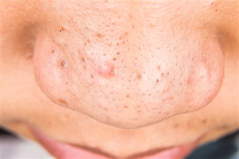 deep pore acne healthfully