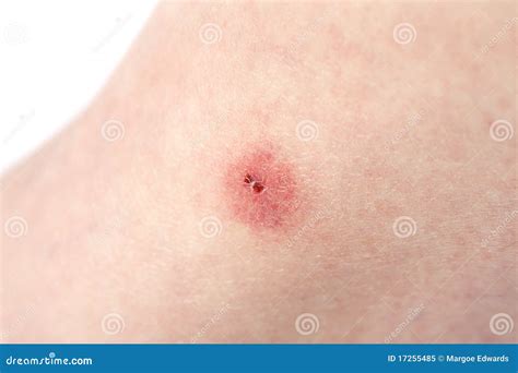 insect bite stock image image  insect irritant horizontal