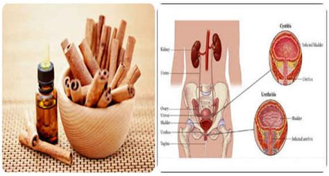 Amazing Remedies To Prevent Urinary Tract Infection