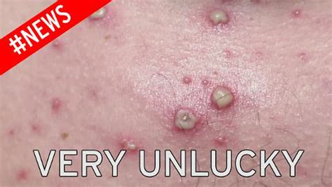 This Close Up Footage Of A Man With A Severe Case Of Chickenpox Shows