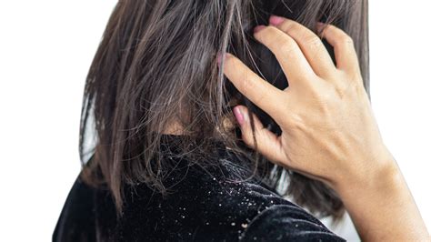 conditioner worsen dandruff