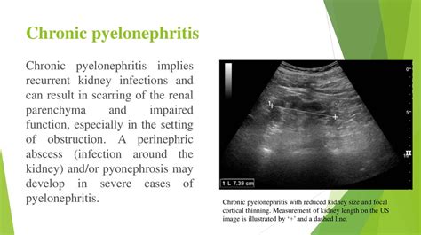 acute  chronic pyelonephritis prezentatsiya onlayn