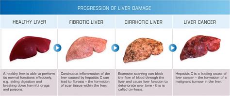 Risk Prevention And Screening Of Liver Cancer