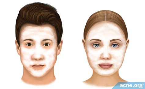 Treating Acne In Male Vs Female Skin