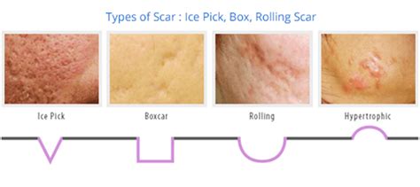 Acne And Acne Scars