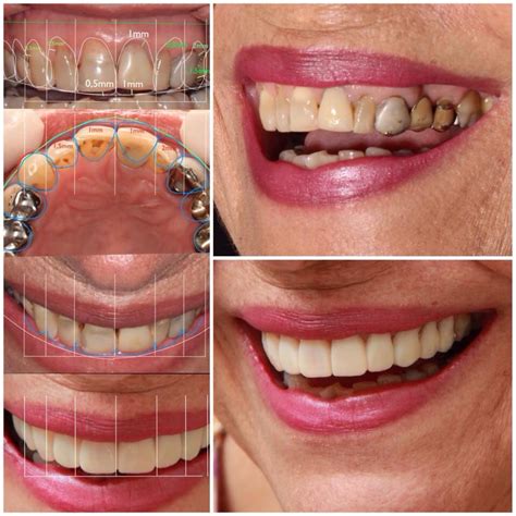 diseno de sonrisa estetica dental odontologia estetica implantes