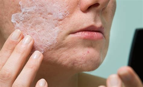 altreno    topical treatment  acne vulgaris