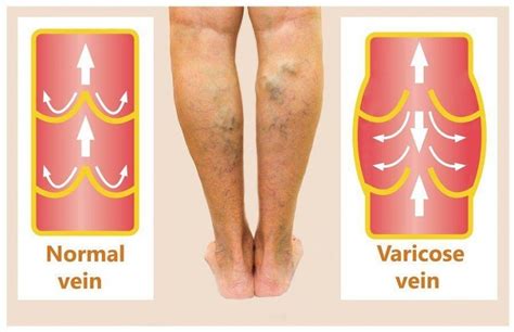 varicose veins treatment complete guide  varicose veins