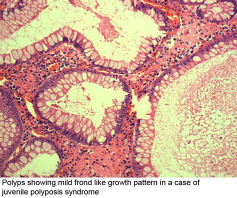 pathology outlines juvenile retention polyp