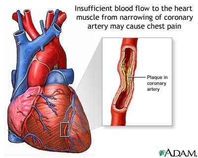 heartache ischemic heart disease angina pectoris myocardial infarction