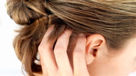 scalp psoriasis tips you can try today everyday health