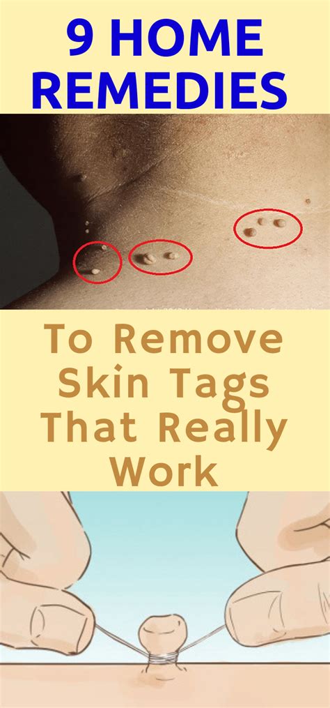 daily health advisor 9 home remedies to remove skin tags that really work