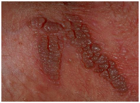 genital warts pictures symptoms causes treatment prevention
