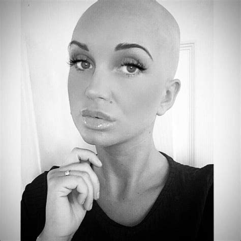 alopecia sufferer sick of hiding bald patches shaves her head metro news