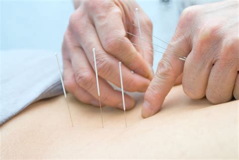 acupuncture treatment how it works benefits and risks